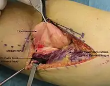 Intraoperative photo.