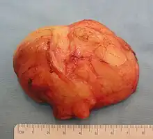 The resected lipoma(8 cm × 6 cm × 3 cm)