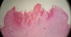 Low magnification micrograph of a molluscum contagiosum lesion