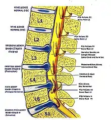 Lumbar disc lesions, classification