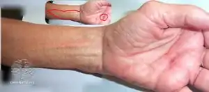 Lymphangitis following accidental wound