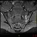 T1-weighted MRI with fat suppression after administration of gadolinium contrast showing sacroiliitis in a person with ankylosing spondylitis