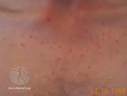 Malassezia folliculitis