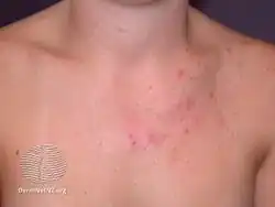 Malassezia folliculitis