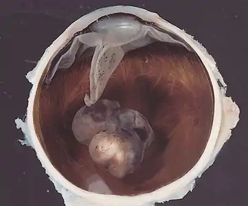 Variably pigmented, mushroom-shaped choroidal tumor has ruptured the Bruch membrane and grown into the subretinal space.