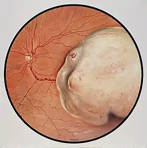 Malignant melanoma of the choroid