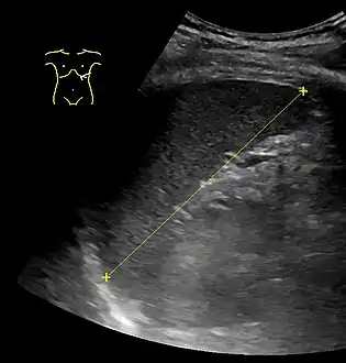 Maximum dimension of the spleen on abdominal ultrasonography