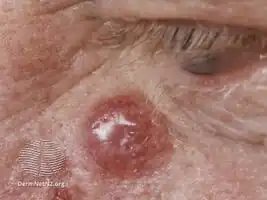 Merkel cell carcinoma