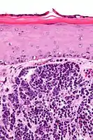 Micrograph of a Merkel-cell carcinoma. H&E stain