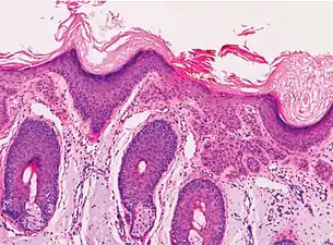 Superficially invasive cutaneous squamous-cell carcinoma. These lesions often do not show the marked pleomorphism and atypical nuclei of cSCC in situ, but manifest early keratinocyte invasion of the dermis.