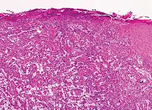 Moderately differentiated lesions of invasive cSCC show much less organization and maturation with significantly less keratin formation.