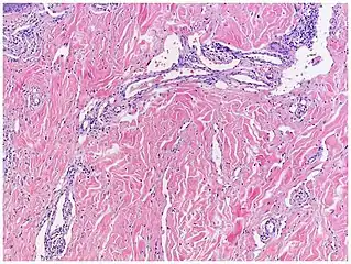 Micrograph of promontory sign in Kaposi's sarcoma in patch stage. Dilated irregular vascular channels surround a pre-existing vessel.