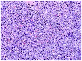 Micrograph of tumor stage. Well-circumscribed spindle-cell tumor. Erythrocytes lie within poorly defined slit-like vascular spaces.