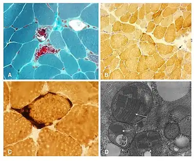 Muscle biopsy of a person diagnosed with MELAS but carrying no known mutation. (a) Modified Gomori trichrome stain showing several ragged red fibers (arrowhead). (b) Cytochrome c oxidase stain showing Type-1 lightly stained and Type II fibers, darker fibers, and a few fibers with abnormal collections of mitochondria (arrowhead). Note cytochrome c oxidase negative fibers as usually seen in mitochondrial encephalopathy, lactic acidosis and stroke-like episodes (MELAS). (c) Succinate dehydrogenase staining showing a few ragged blue fibers and intense staining in the mitochondria of the blood vessels (arrow). (d) Electron microscopy showing abnormal collection of mitochondria with paracrystalline inclusions (arrowhead), osmiophilic inclusions (large arrowhead) and mitochondrial vacuoles (small arrowhead).