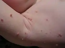 Molluscum lesions on an arm