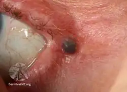 Hidrocystoma of the eyelid