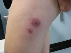 Mycobacterium chelonae abscesses associated with biomesotherapy, an alternative therapy practice. (The abscesses are at the biomesotherapy injection site).