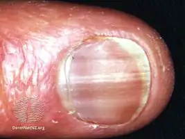 Nail pigmentation due to hydroxyurea