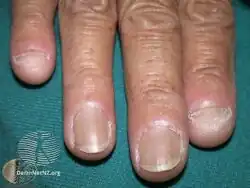 Nail psoriasis