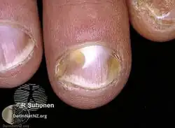 Nail psoriasis