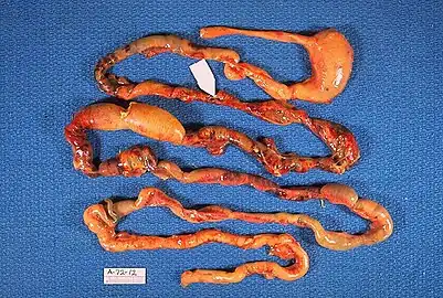 Alimentary tract of infant showing intestinal necrosis, pneumatosis intestinalis, and perforation site (arrow). Autopsy.