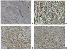 Neuropilin-2 expression in normal breast and breast carcinoma tissue.