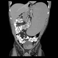 Non-Hodgkin lymphoma - splenic involvement