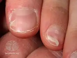 Onychomadesis following hand foot and mouth disease