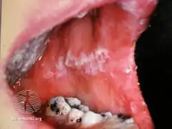 Oral candidiasis