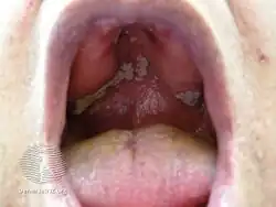 Oral candidiasis