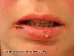 Oral pemphigus