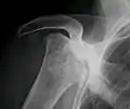 Radiography of total avascular necrosis of right humeral head. Woman of 81 years with diabetes of long evolution.