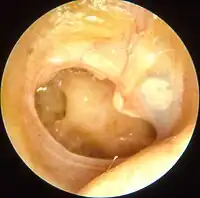 Otitis media chronica mesotympanalis