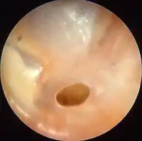 Otitis media chronica mesotympanalis