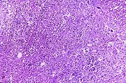 This photomicrograph of a hematoxylin-eosin (H&E) stained tissue sample of cervical spinal cord, reveals how it was affected by the polio type-III virus.