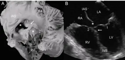 a,b)Atrioventricular septal defect with two separate atrioventricular valves.