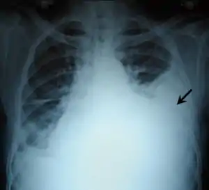 Massive pleural effusion, later proven to be hemothorax