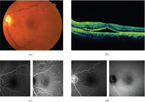 a) Image shows serous retinal detachment b) OCT shows retinal detachment involving the fovea c) early phase images of FA  and IA d) Late phase images of FA and IA