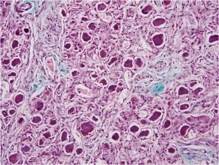 Stellate ganglion  (sample of cardiac septum) was found to demonstrate fibrosis suggestive of cardiovascular disease