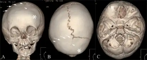 Anterior plagiocephaly- a)Anterior b) vertex  and c) endocranial