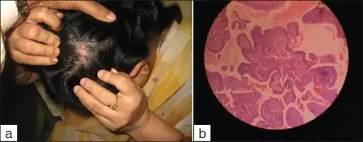 a) Syringocystadenoma papilliferum over a pre-existing nevus-sebaceous b) histopathology of syringocystadenoma papilliferum showing cystic invagination of surface epithelium