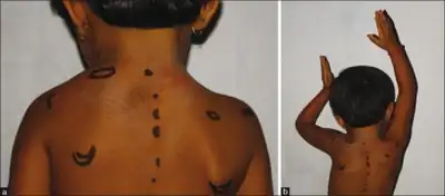 a) Marked elevation of  left scapula b)restriction of abduction