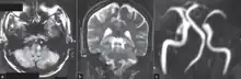 a)High signal in  left postero lateral indicates a  infarct  and  thrombosed left vertebral artery  b) infarct (circle ) c)indicates absence of normal left vertebral artery ( circle )