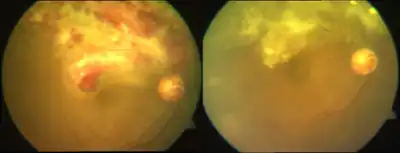 Pre- left and post-treatment right with ganciclovir.