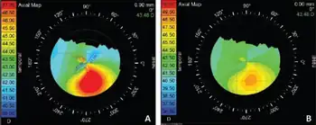 Topography of individual with keratoconus a) having steps  0.5 D and b) having steps of 1.0 D