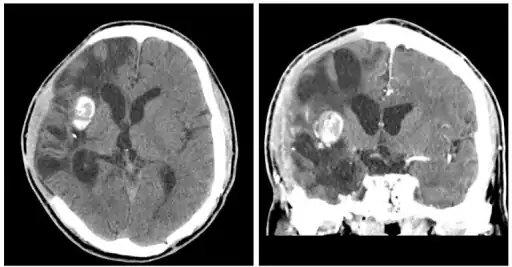 CT scans  show calcified brain abscess.