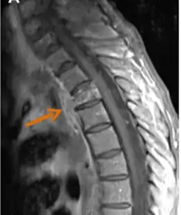 Contrast-enhanced magnetic resonance images showing contiguous spread of pulmonary actinomycosis to the spine