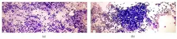 a)Lymphocytic (Hashimoto) thyroiditis-polymorphous lymphoid population b) Lymphocytic (Hashimoto) thyroiditis-lymphohistiocytic aggregates