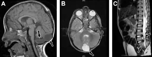 Caudal regression syndrome-a) Brain MRI shows 2 cystic structures at the region of cisterna magna  b) cyst is also shown on axial T2-weighted image c) MRI dorsolumbar spine showing abrupt cutoff and bulbar configuration of conus medullaris at the level of L1