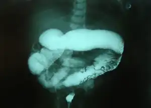 Barium enema in neonate with Hirschsprung disease